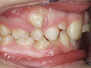 Before - Ali Orthodontics Dental