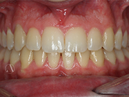 After - Ali Orthodontics Dental