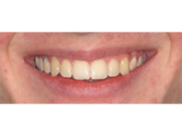 After - Ali Orthodontics Dental