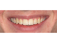 After - Ali Orthodontics Dental