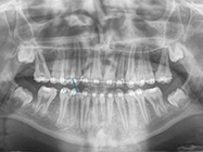 After - Ali Orthodontics Dental