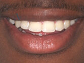 After - Ali Orthodontics Dental