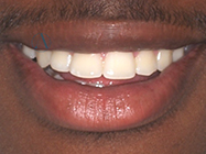 After - Ali Orthodontics Dental