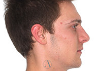 After - Ali Orthodontics Dental