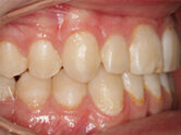 After - Ali Orthodontics Dental