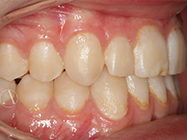 After - Ali Orthodontics Dental