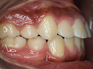 After - Ali Orthodontics Dental