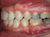 After - Ali Orthodontics Dental