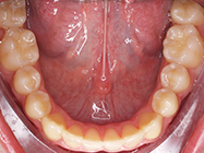 After - Ali Orthodontics Dental