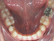 After - Ali Orthodontics Dental