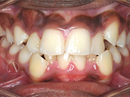 Before - Ali Orthodontics Dental