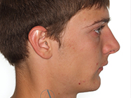 Before - Ali Orthodontics Dental