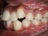 Before - Ali Orthodontics Dental