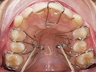 After - Ali Orthodontics Dental