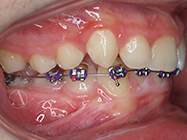 After - Ali Orthodontics Dental