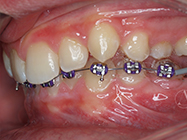 After - Ali Orthodontics Dental