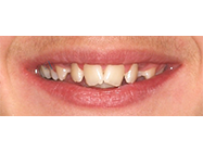 Before - Ali Orthodontics Dental