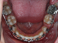 After - Ali Orthodontics Dental