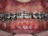 After - Ali Orthodontics Dental