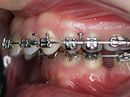 After - Ali Orthodontics Dental