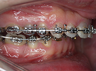 After - Ali Orthodontics Dental