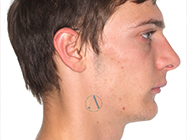 After - Ali Orthodontics Dental