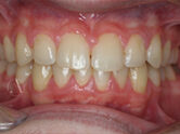 After - Ali Orthodontics Dental