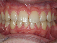 After - Ali Orthodontics Dental