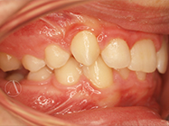 Before - Ali Orthodontics Dental