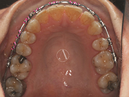 After - Ali Orthodontics Dental