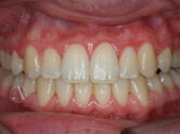 After - Ali Orthodontics Dental