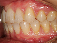 After - Ali Orthodontics Dental