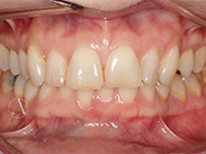 Before - Ali Orthodontics Dental