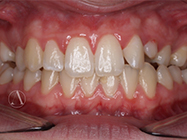 Before - Ali Orthodontics Dental