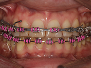 After - Ali Orthodontics Dental