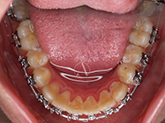 After - Ali Orthodontics Dental