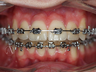 After - Ali Orthodontics Dental