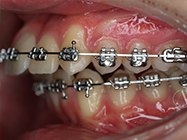 After - Ali Orthodontics Dental