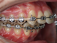 After - Ali Orthodontics Dental