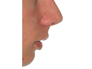 After - Ali Orthodontics Dental