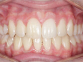 After - Ali Orthodontics Dental