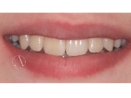 After - Ali Orthodontics Dental