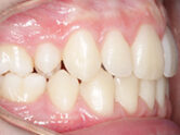 After - Ali Orthodontics Dental