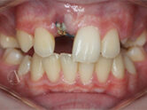 Before - Ali Orthodontics Dental