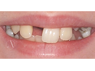 Before - Ali Orthodontics Dental
