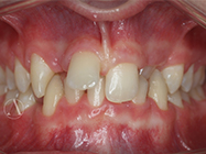 Before - Ali Orthodontics Dental