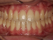 After - Ali Orthodontics Dental