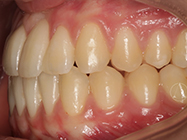 After - Ali Orthodontics Dental