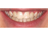 After - Ali Orthodontics Dental