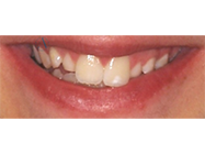 Before - Ali Orthodontics Dental